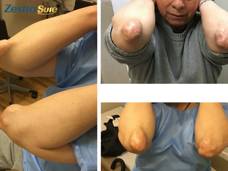 tophi gout removal (2)